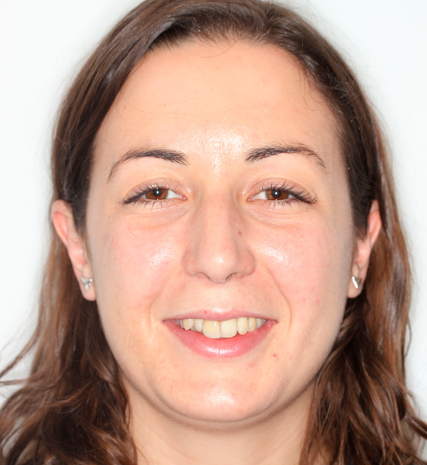 fotografía de antes de Invisalign Full