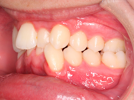 Antes