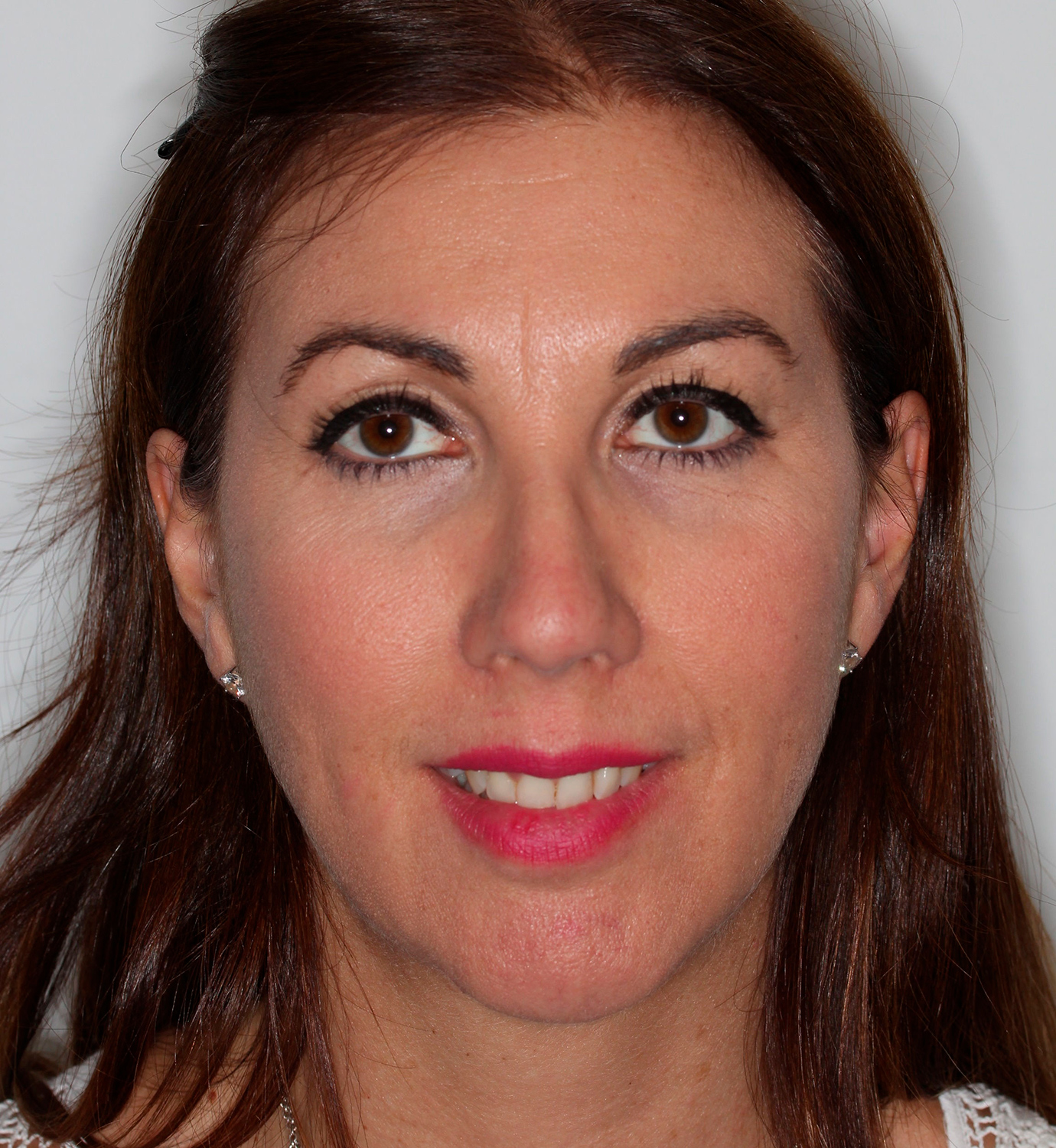 fotografía de antes de ortodoncia con Invisalign