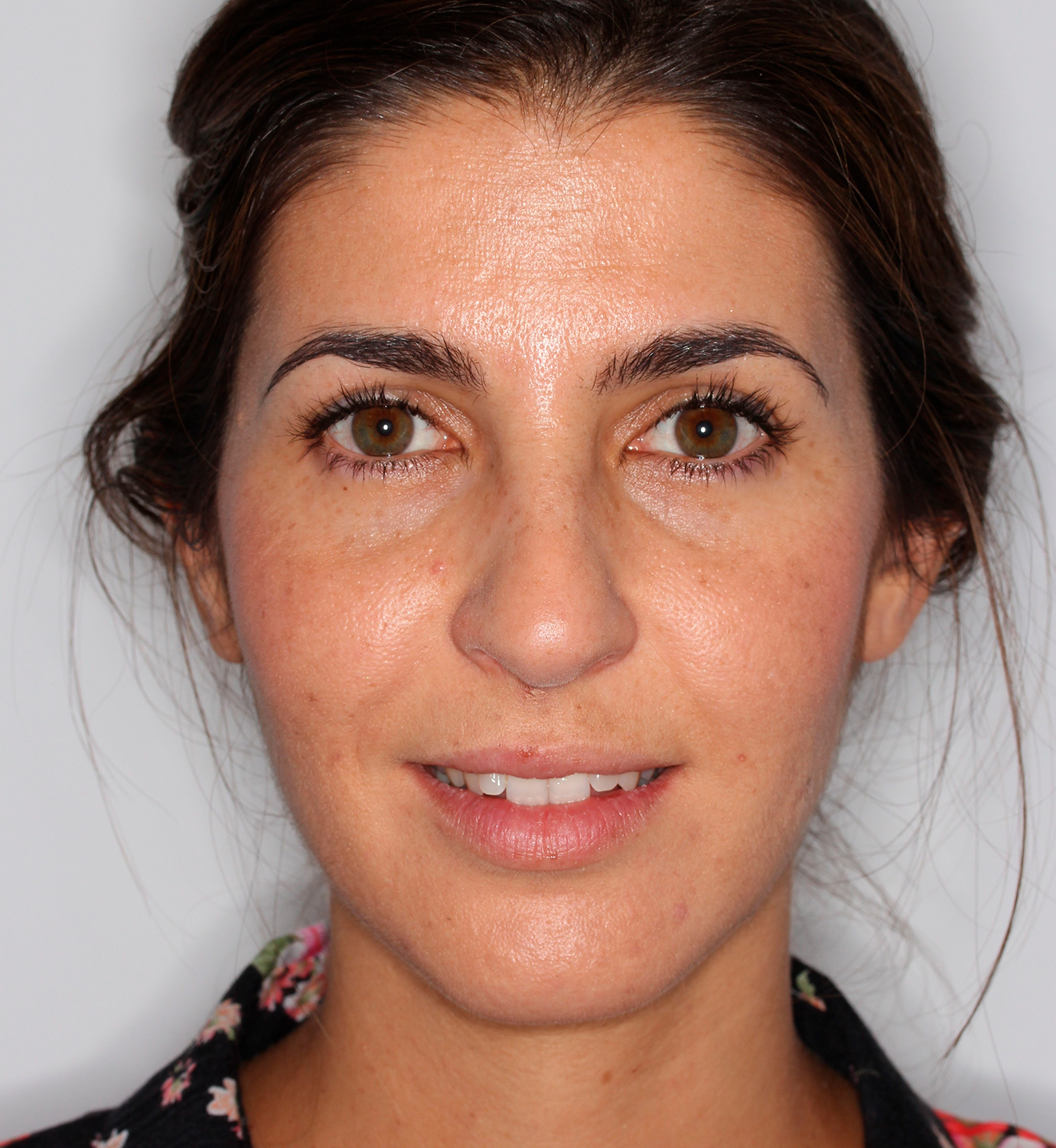 fotografía de antes de ortodoncia con Invisalign