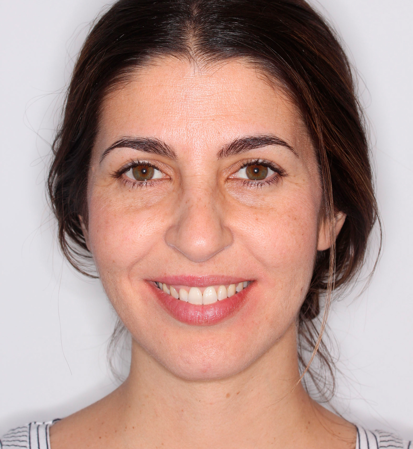 fotografía de después de ortodoncia con Invisalign