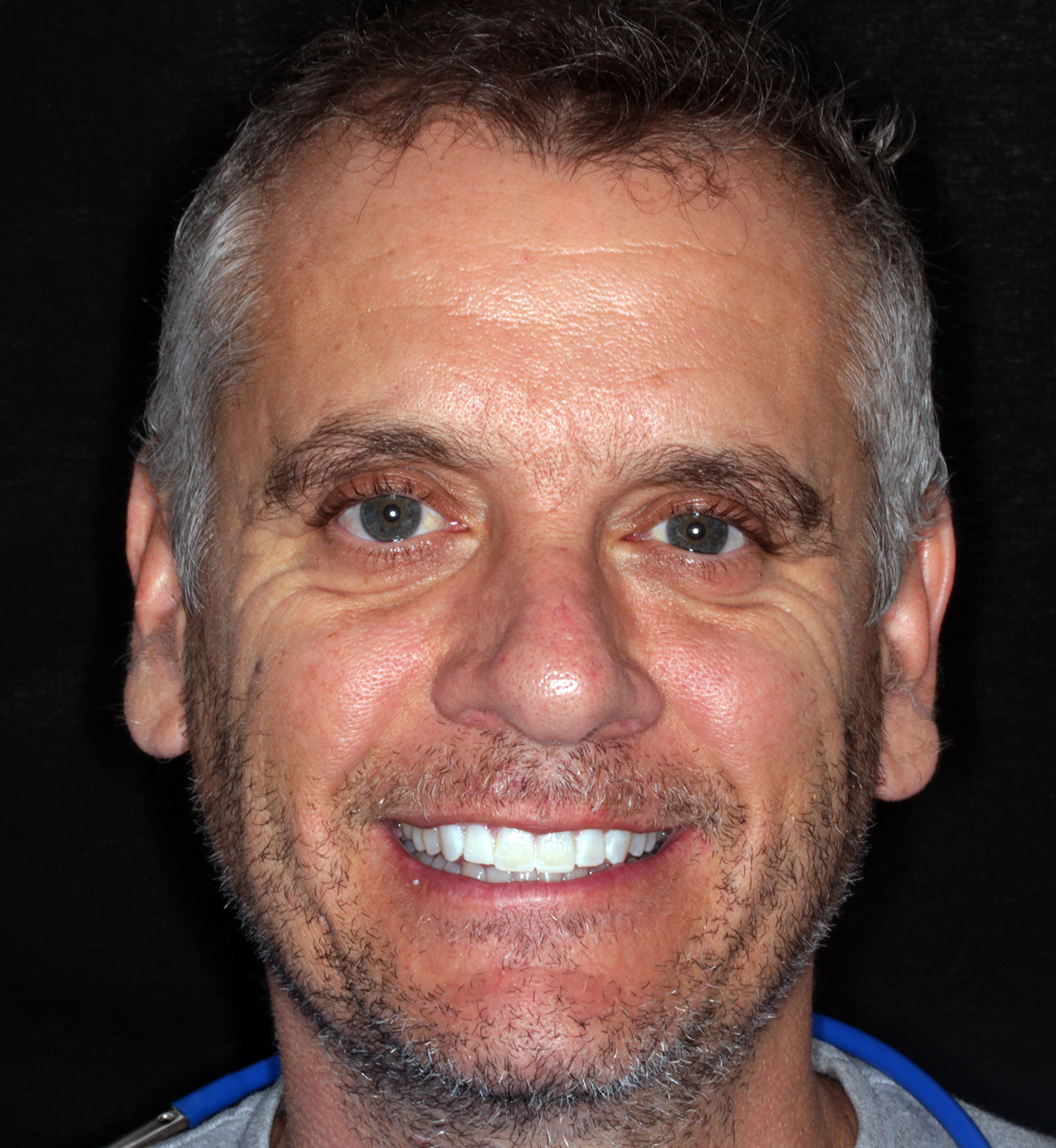 fotografía de después