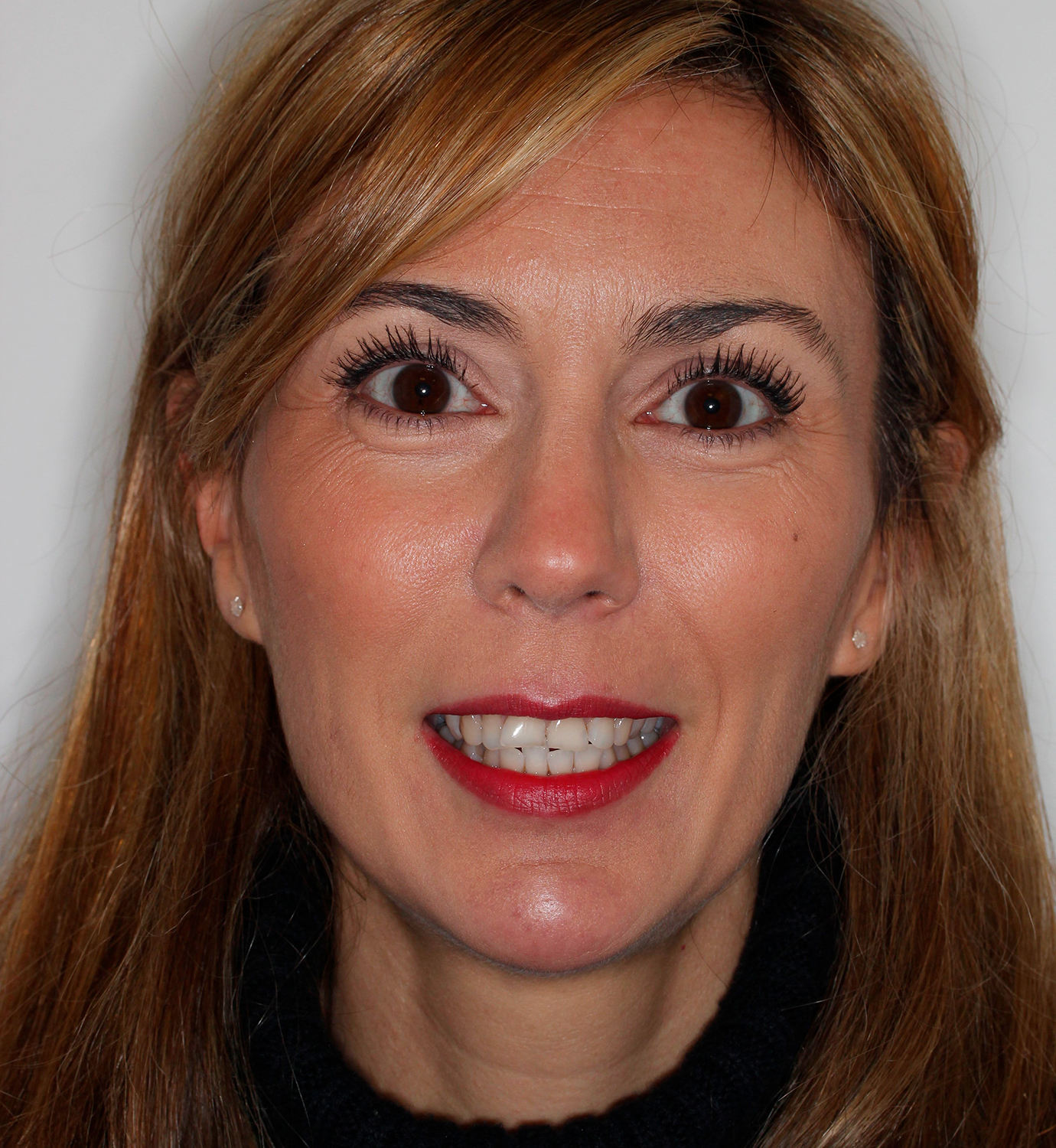 fotografía de antes de ortodoncia con Invisalign