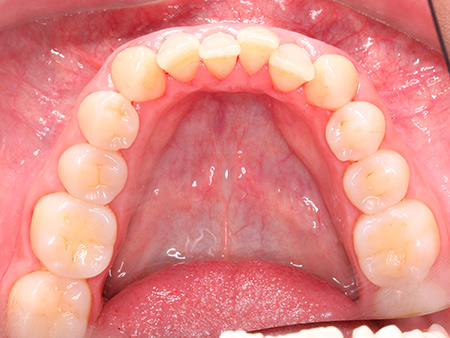 Antes