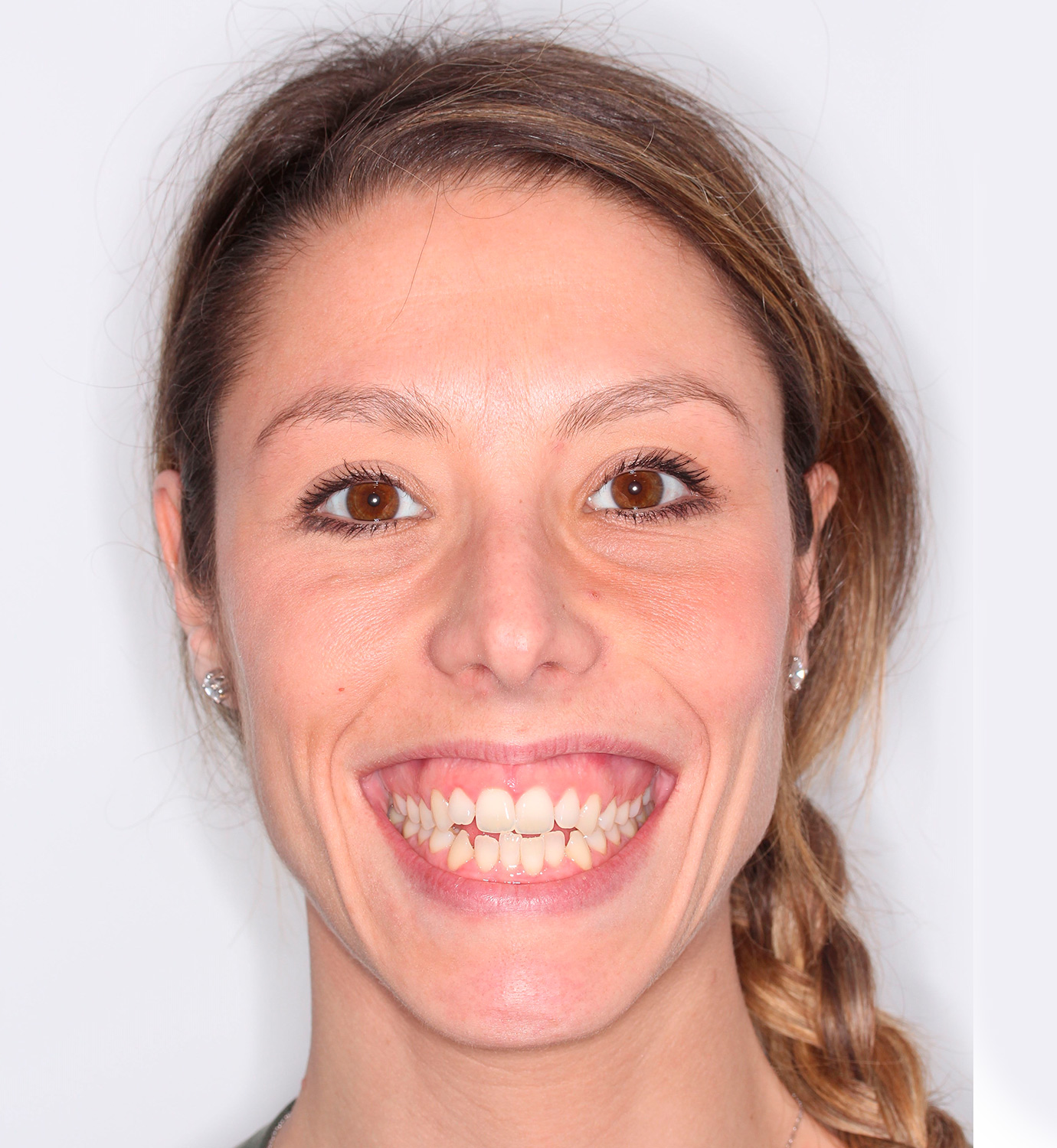 fotografía de antes de ortodoncia con Invisalign