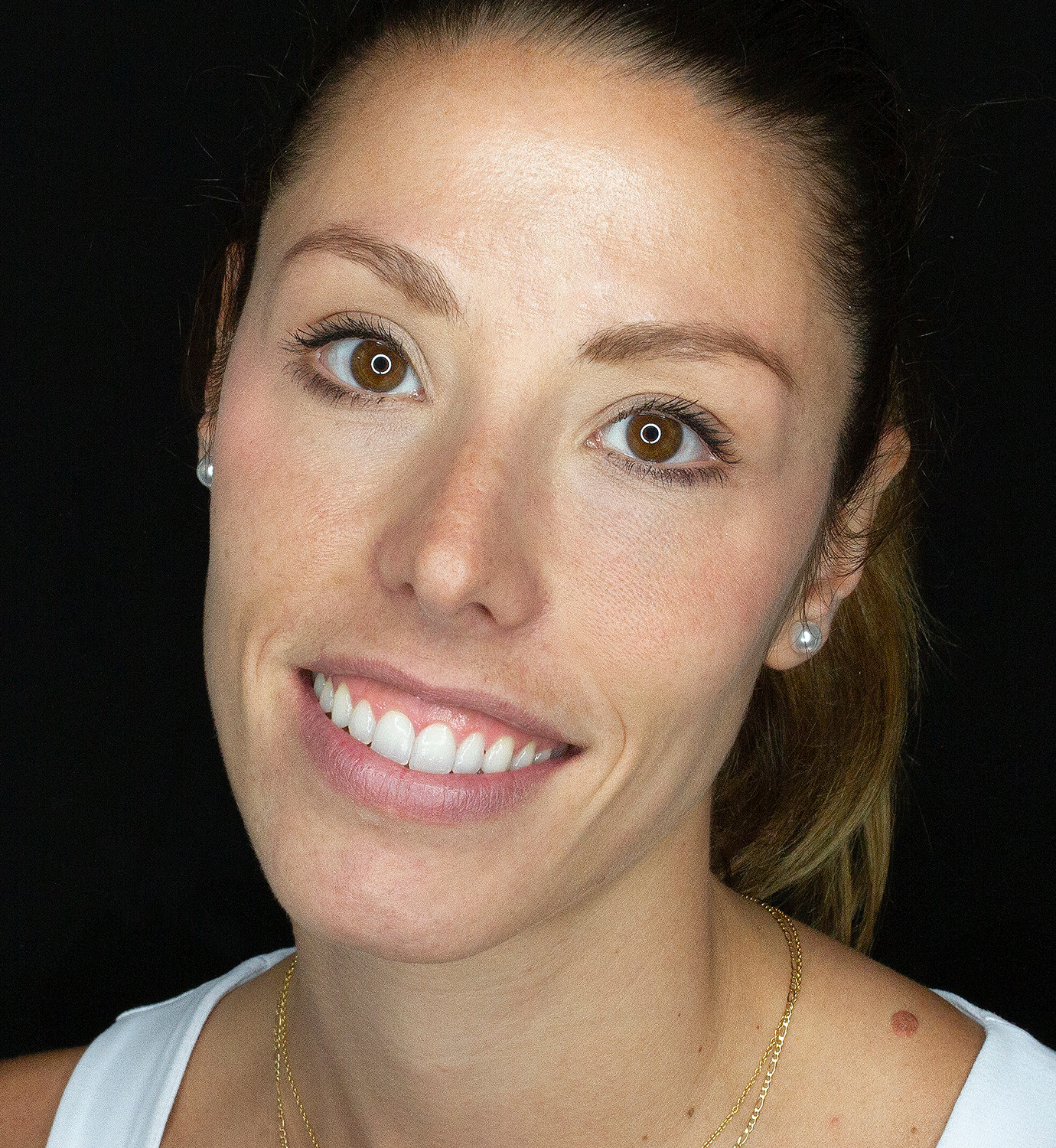 fotografía de después de ortodoncia con Invisalign