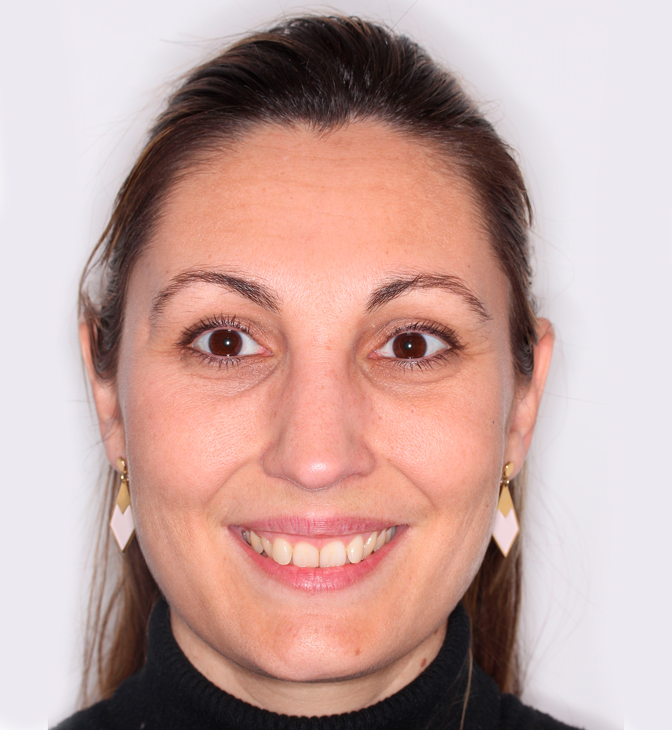 fotografía de antes de ortodoncia con Invisalign