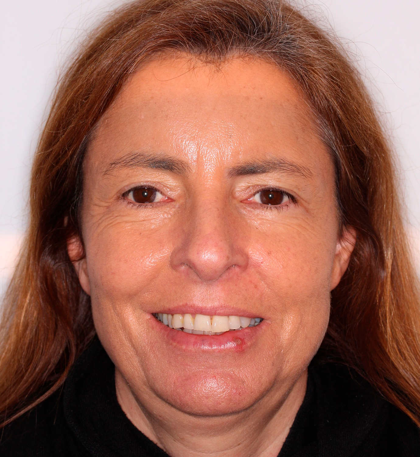 fotografía de antes de ortodoncia con Invisalign