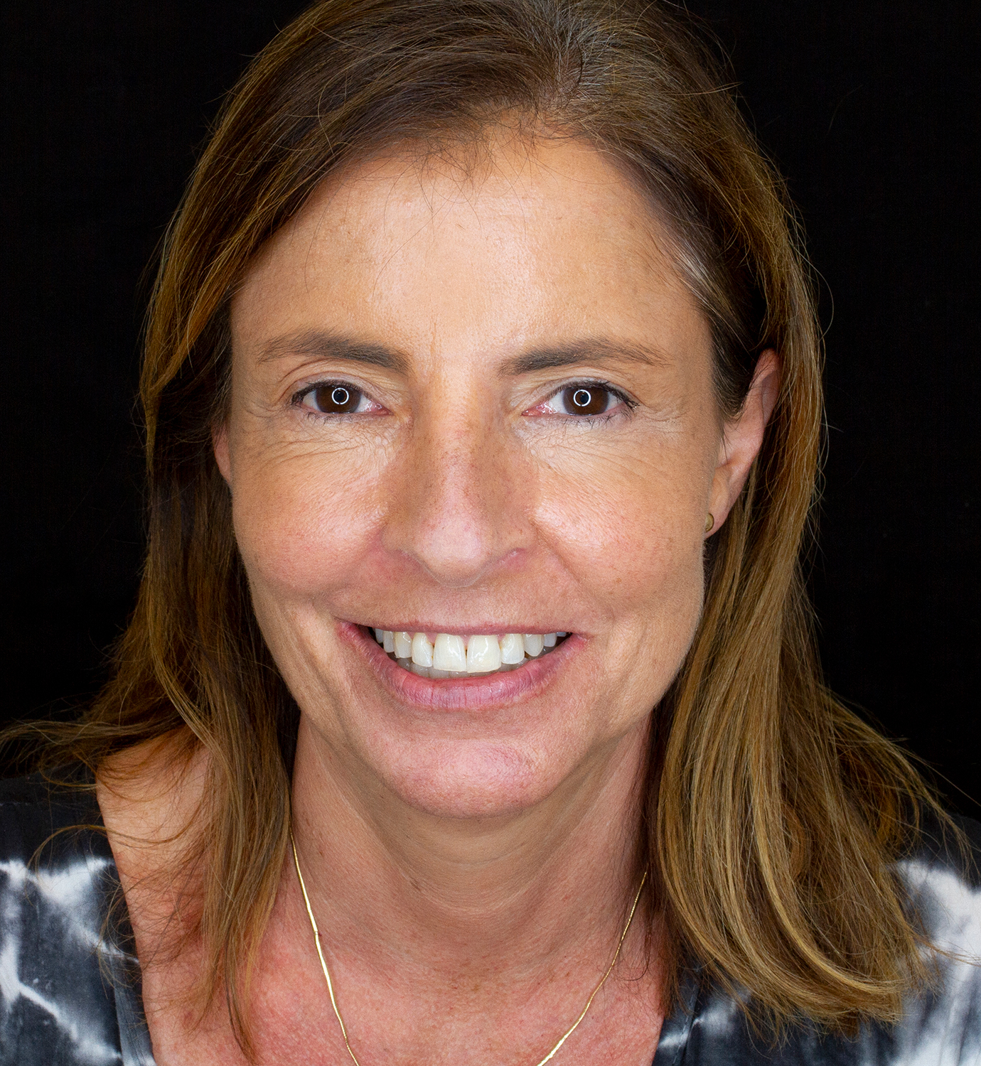 fotografía de después de ortodoncia con Invisalign