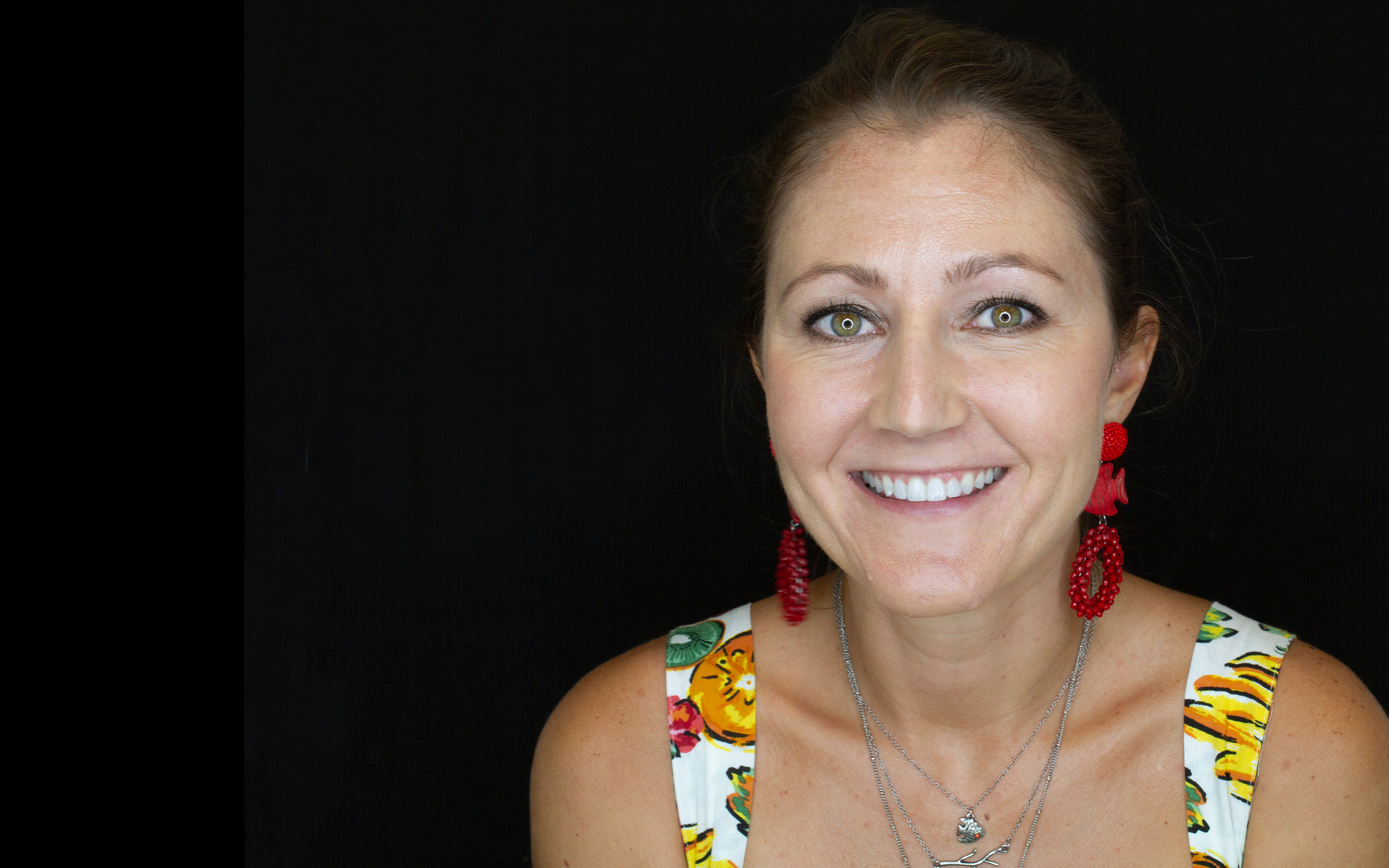 Caso antes y después de ortodoncia con Invisalign