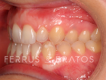 Antes
