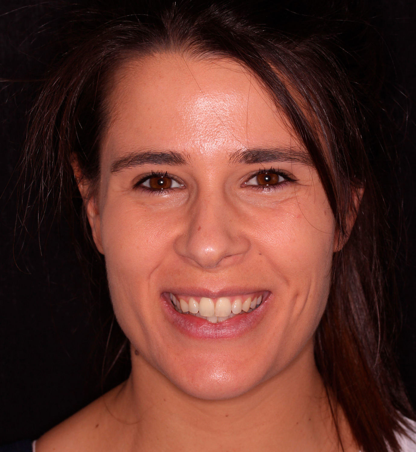 fotografía de antes de ortodoncia con Invisalign