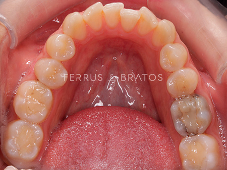 Antes