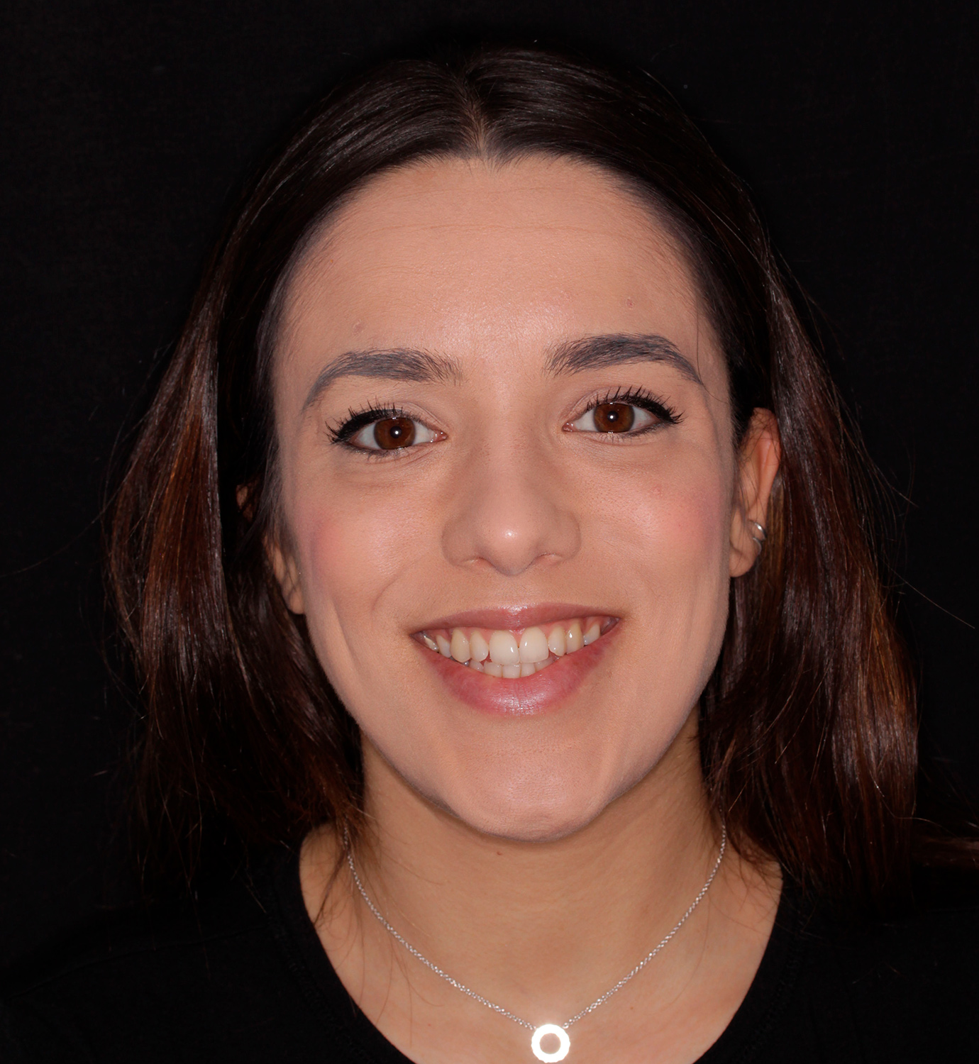 fotografía de antes de ortodoncia con Incognito