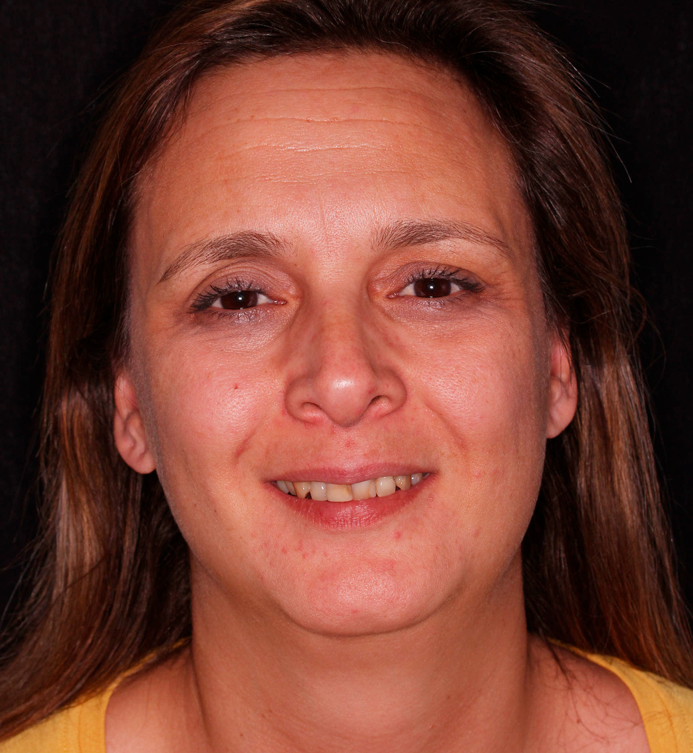 fotografía de antes de ortodoncia con Invisalign