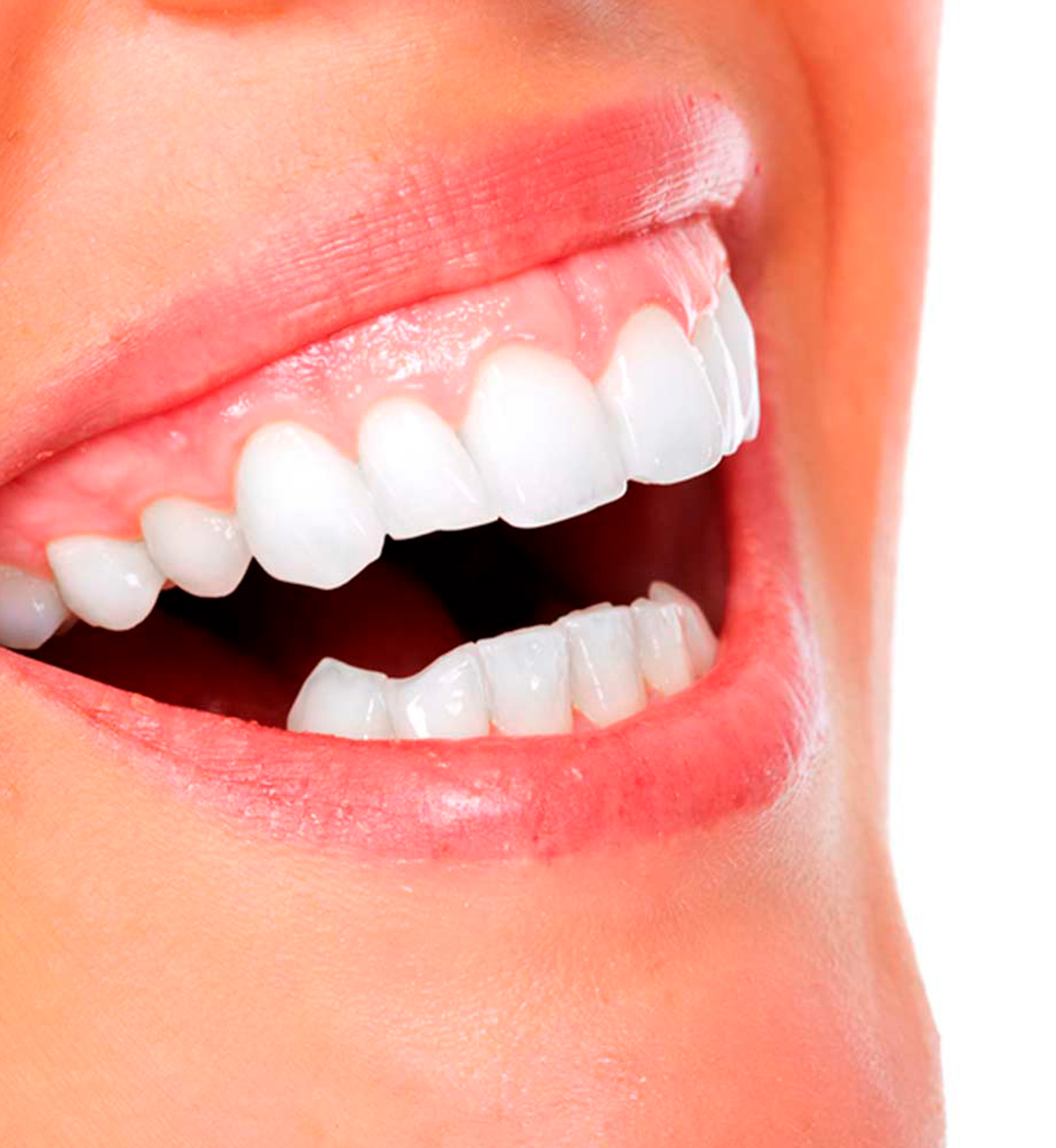 Ventajas de la gingivectomía