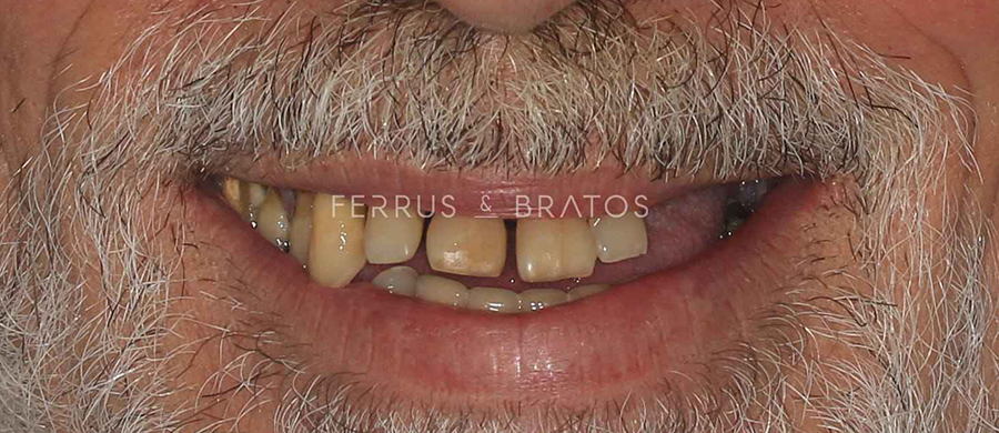 Antes