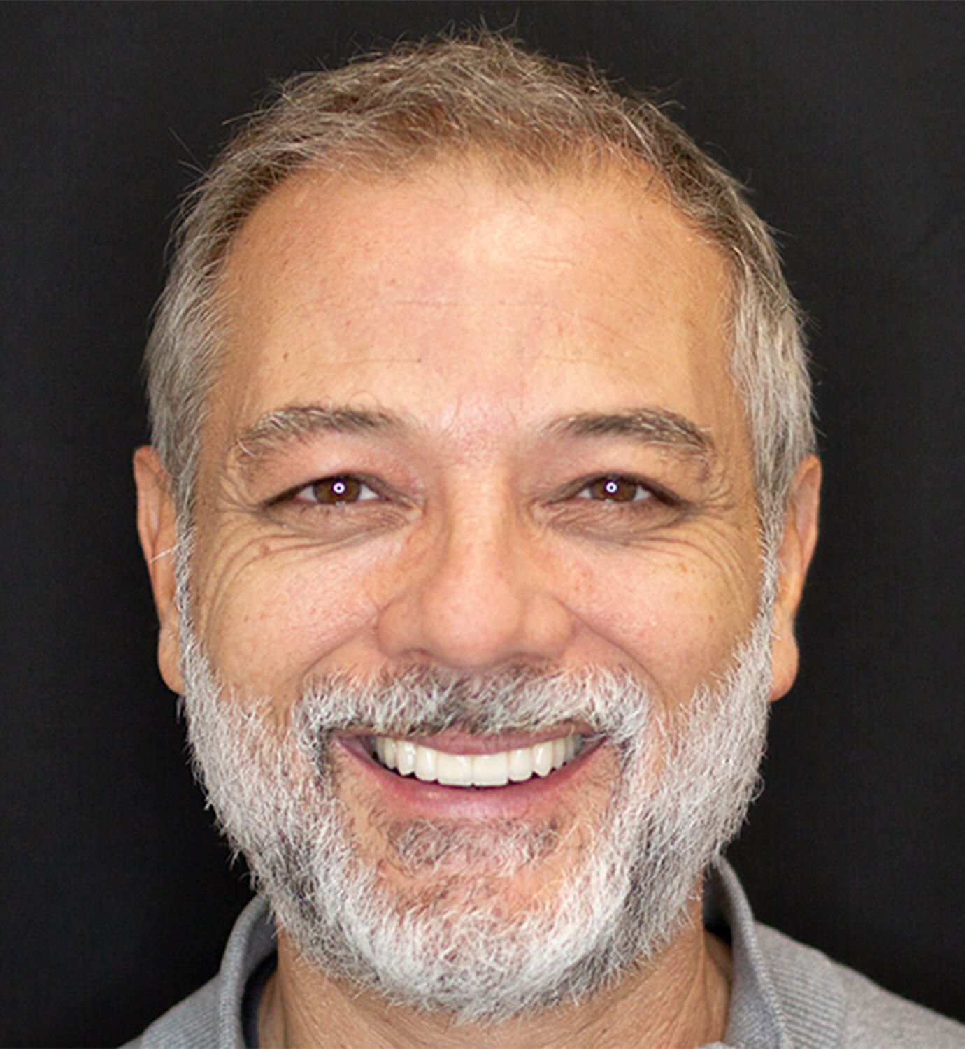 Fotografía de después de caso con implantes