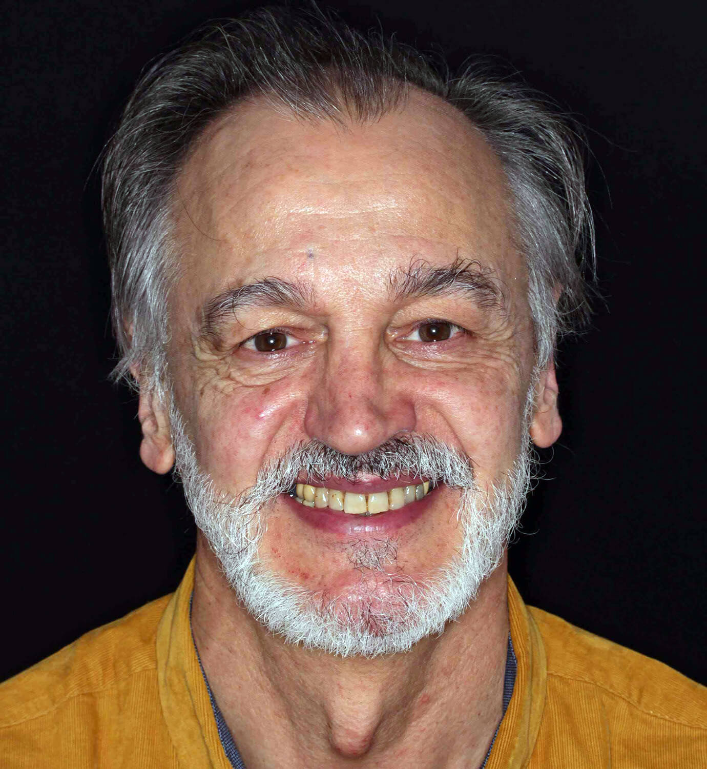 fotografía de antes de ortodoncia con Incognito