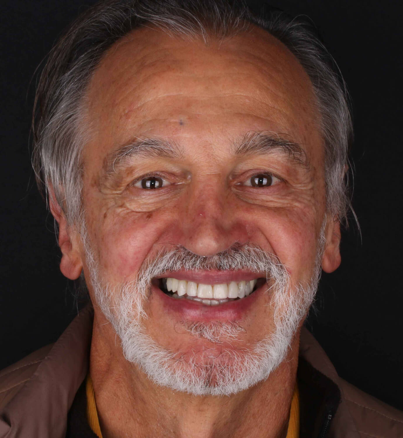 fotografía de después de ortodoncia con Incognito