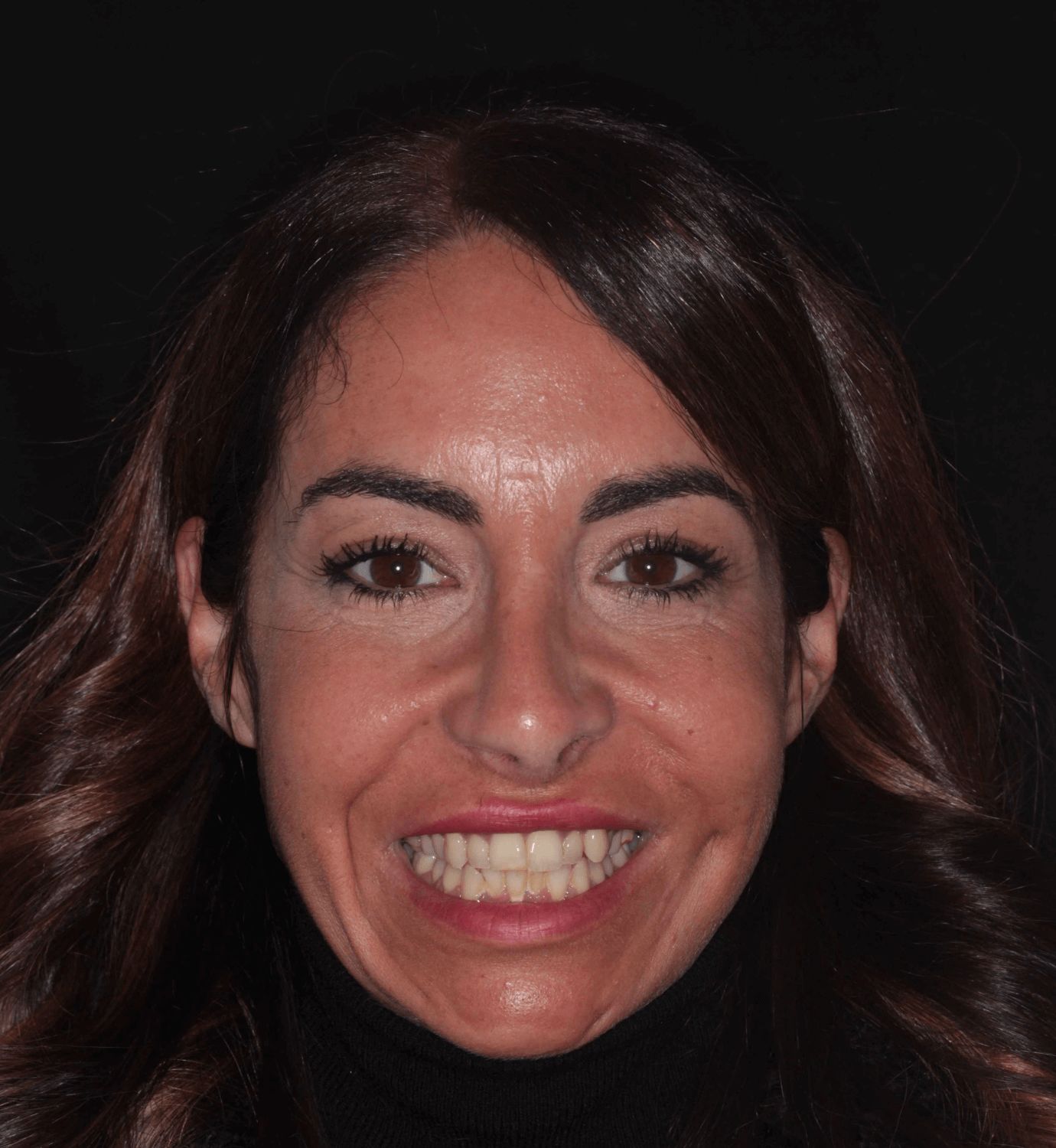 fotografía de antes de ortodoncia con Invisalign