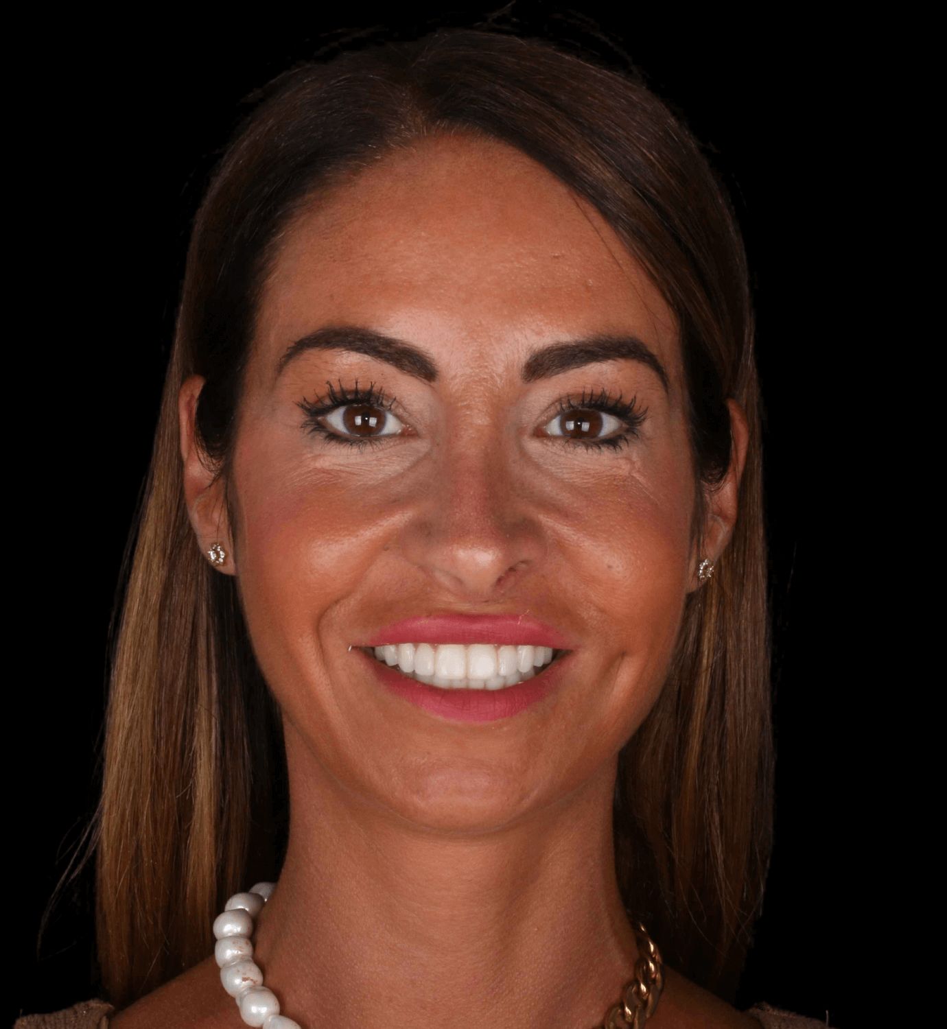 fotografía de después de ortodoncia con Invisalign