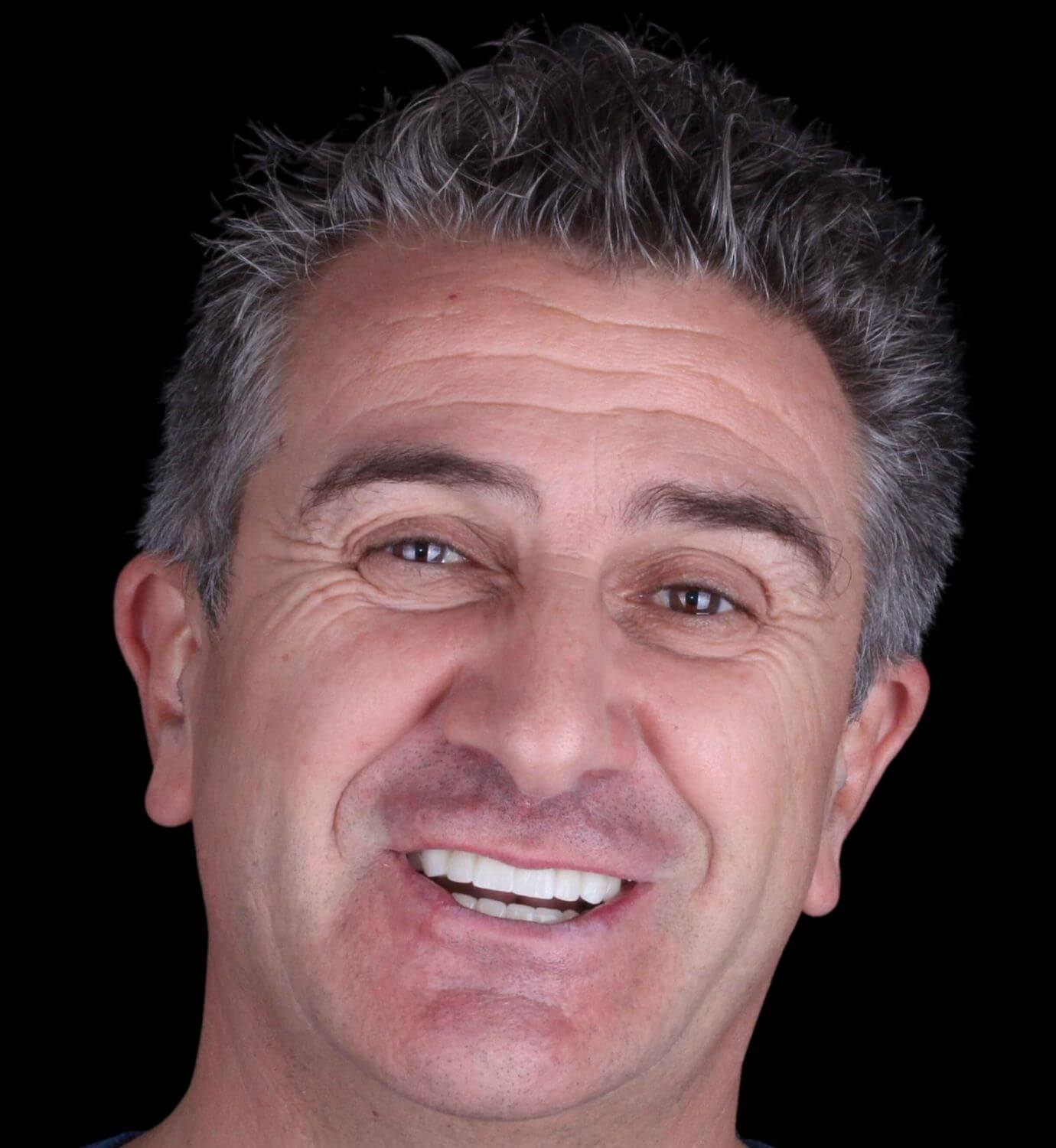 fotografía de después