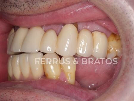 Antes