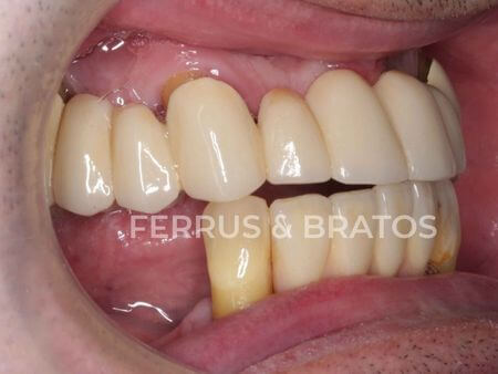 Antes