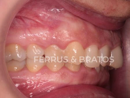 Antes