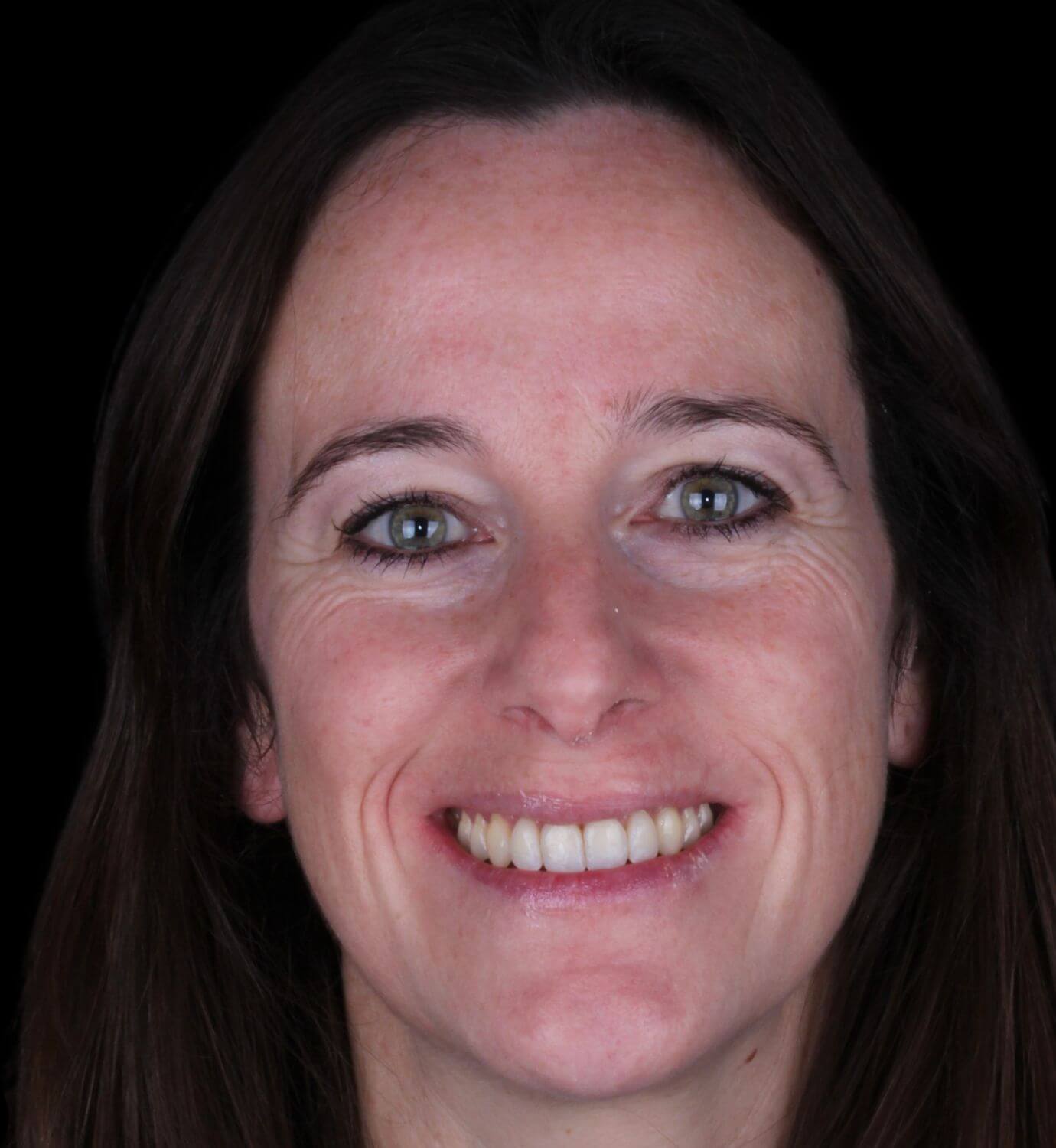 fotografía de después