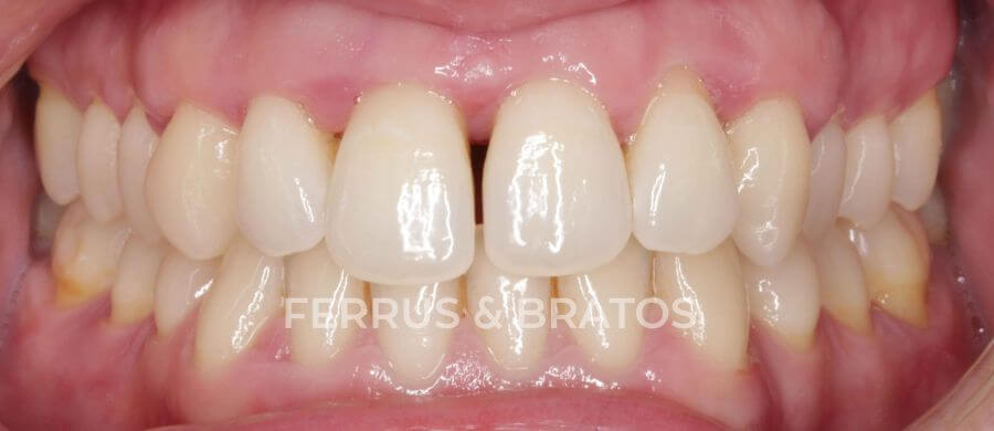 Antes