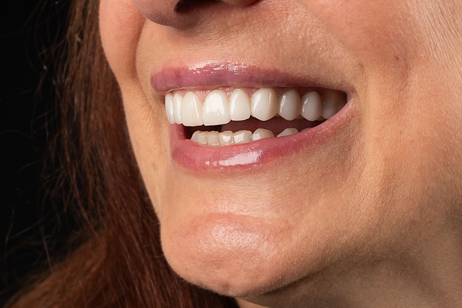 Ciruía guiada para casos de poco hueso