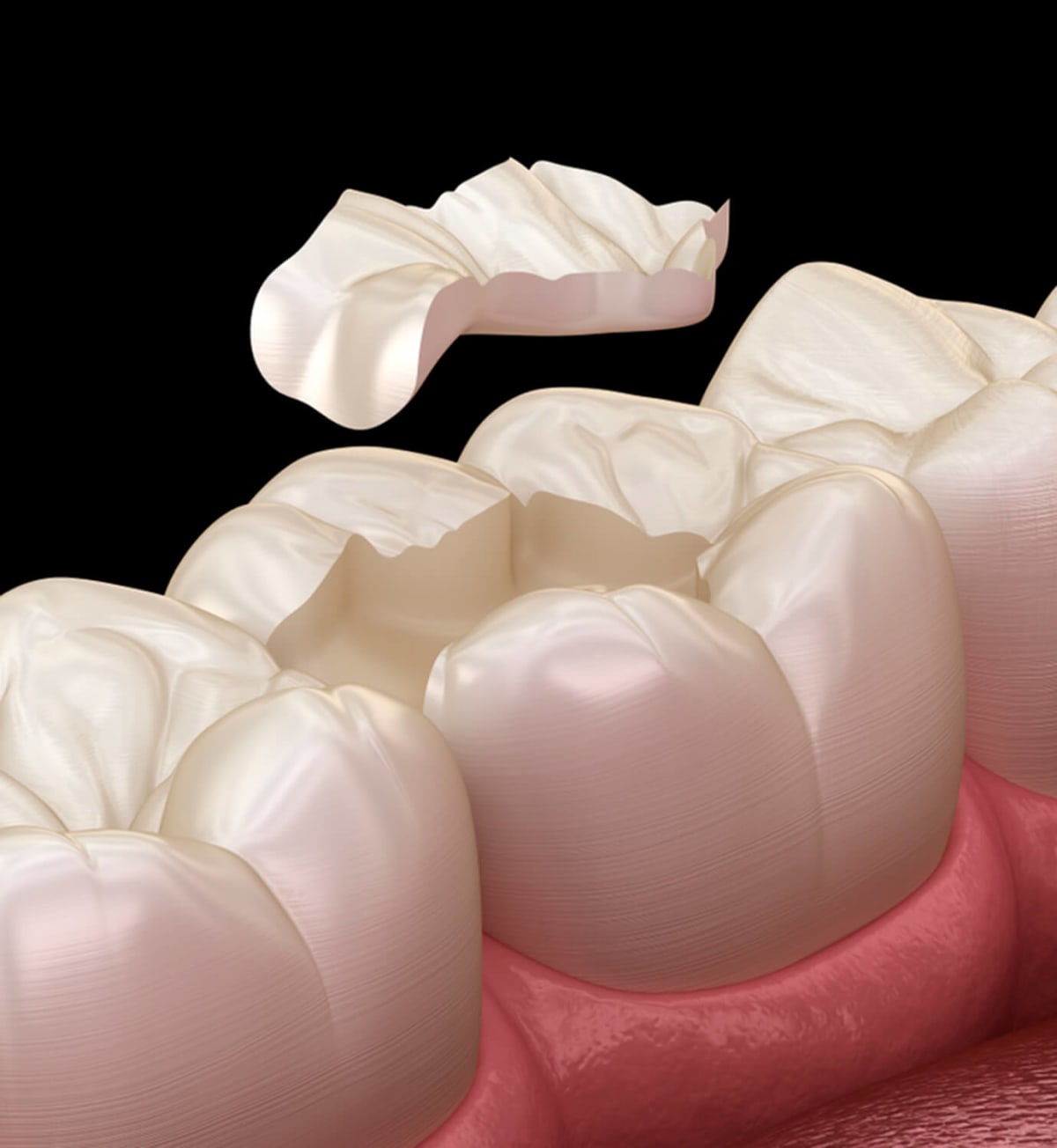 Dentistas especializados en incrustaciones en Madrid