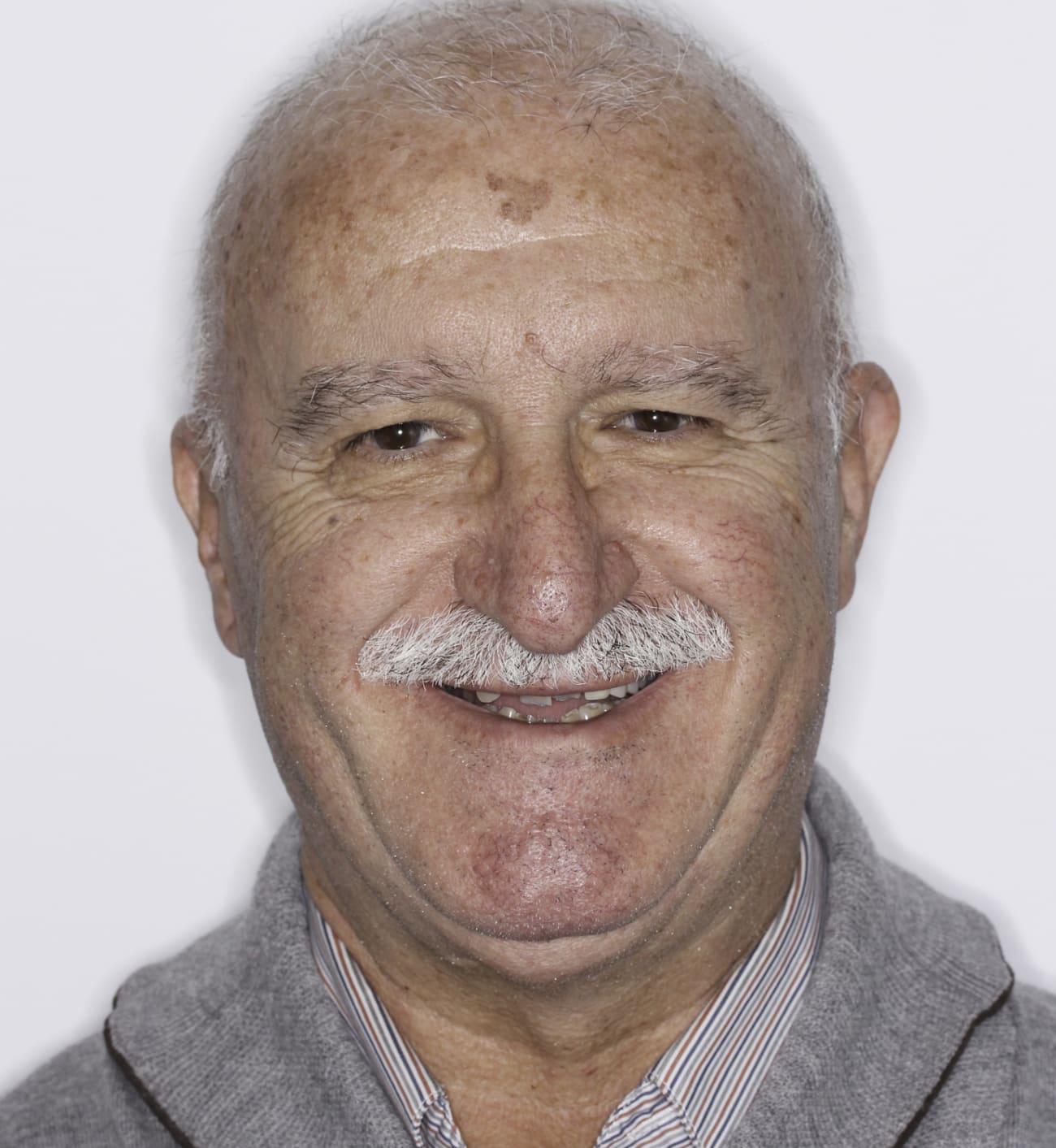 fotografía de antes de ortodoncia con Invisalign