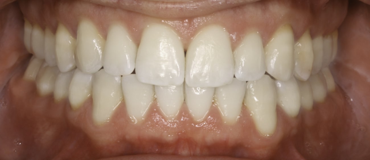 Después de tratamiento periodontal