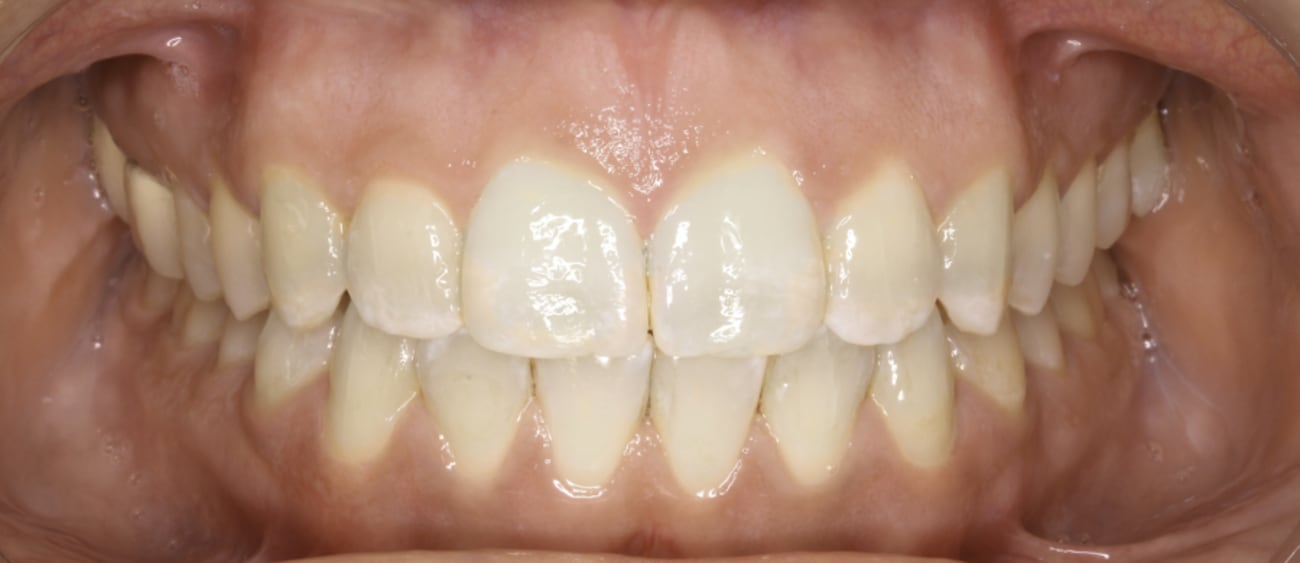 Después de ortodoncia con brackets linguales Incognito