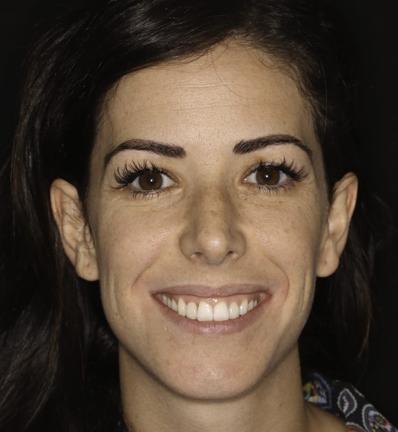 fotografía de sonrisa después tratamiento de ortodoncia