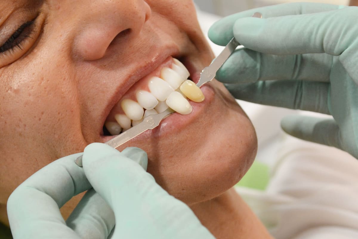 Lo encontré Disciplina Meyella Blanqueamiento dental: tipos, ventajas y precio | 2023 | Ferrus&Bratos