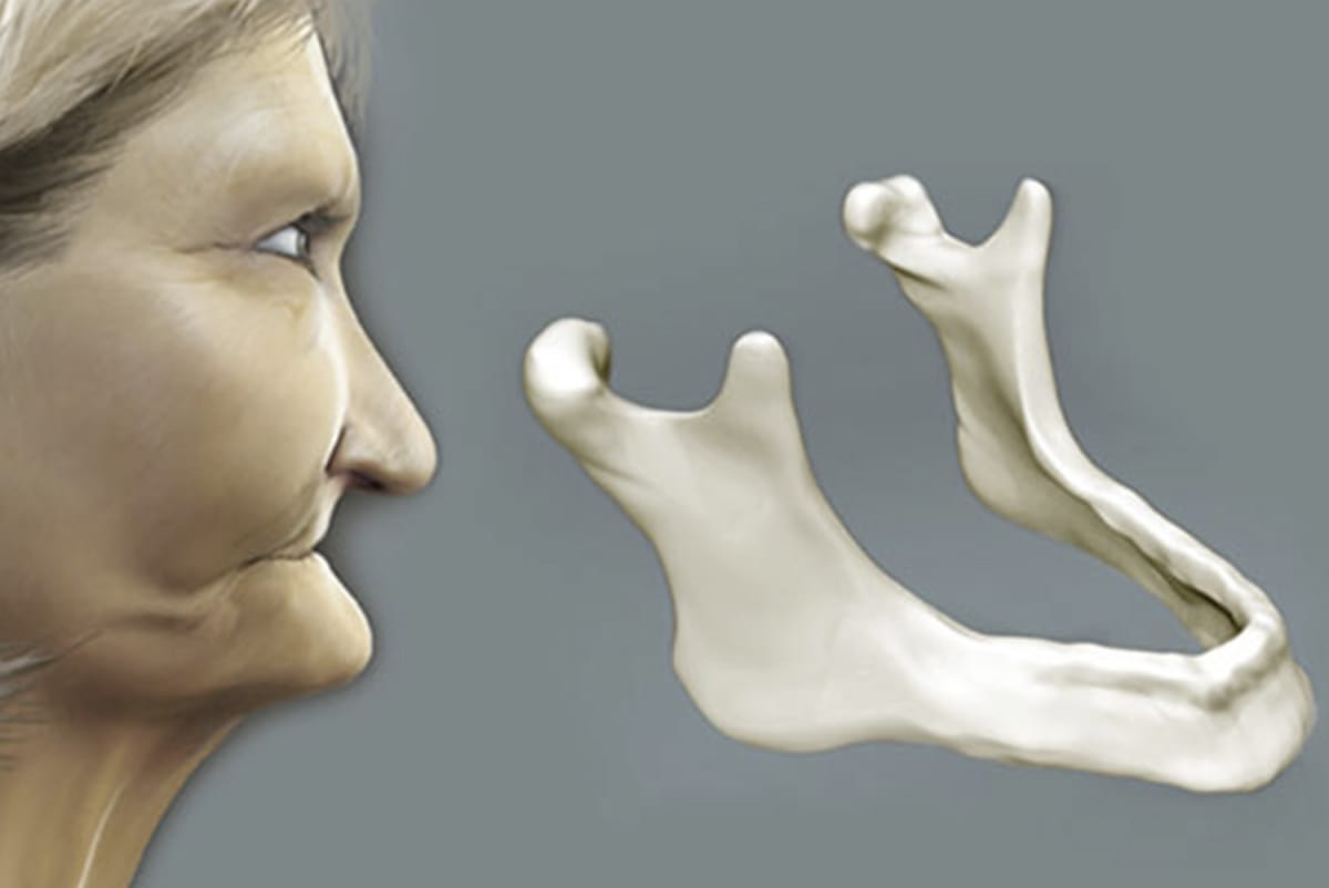 Perdida de peso por dentadura postizar