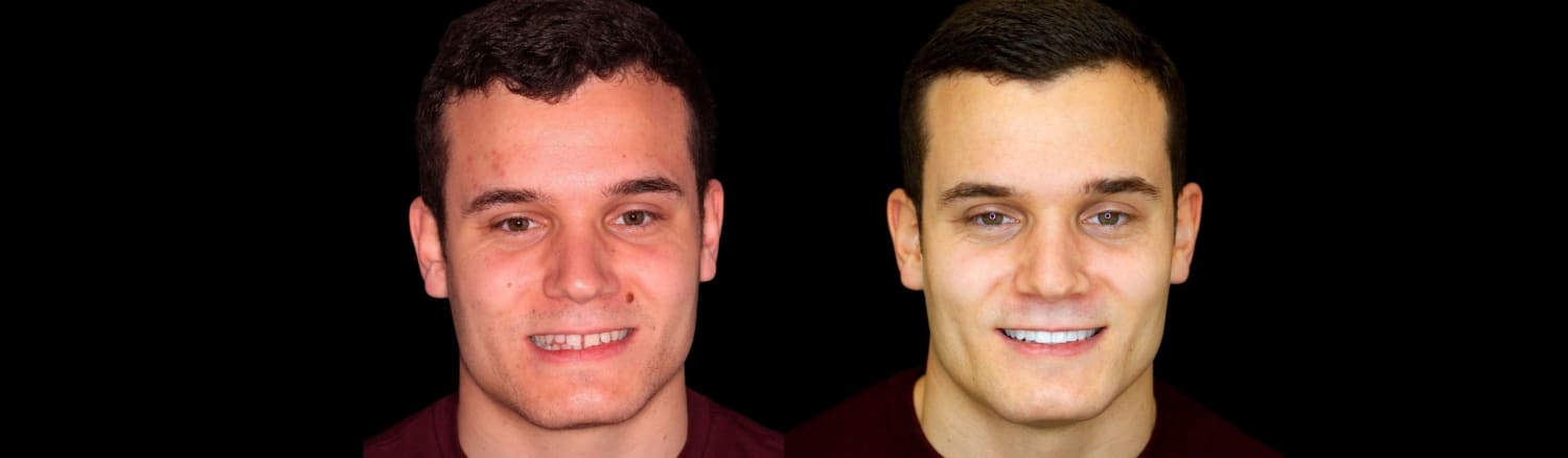 Carillas dentales antes y despues: 6 casos reales