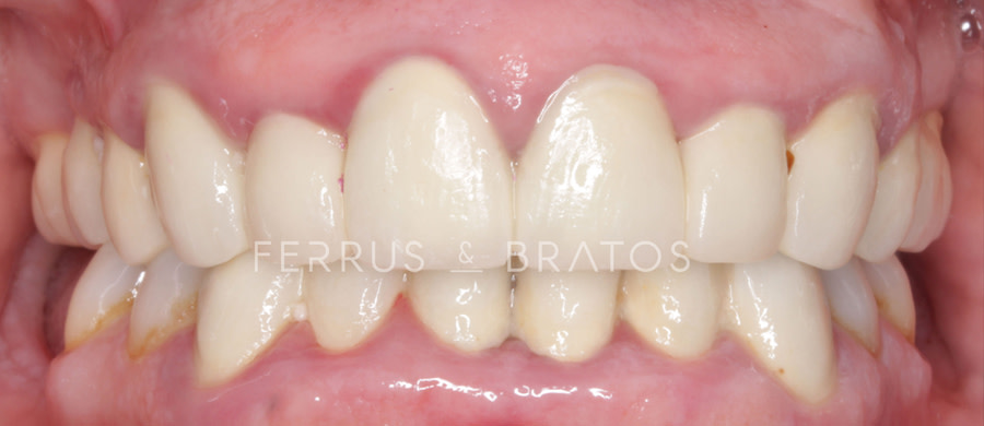 Antes de implantes dentales
