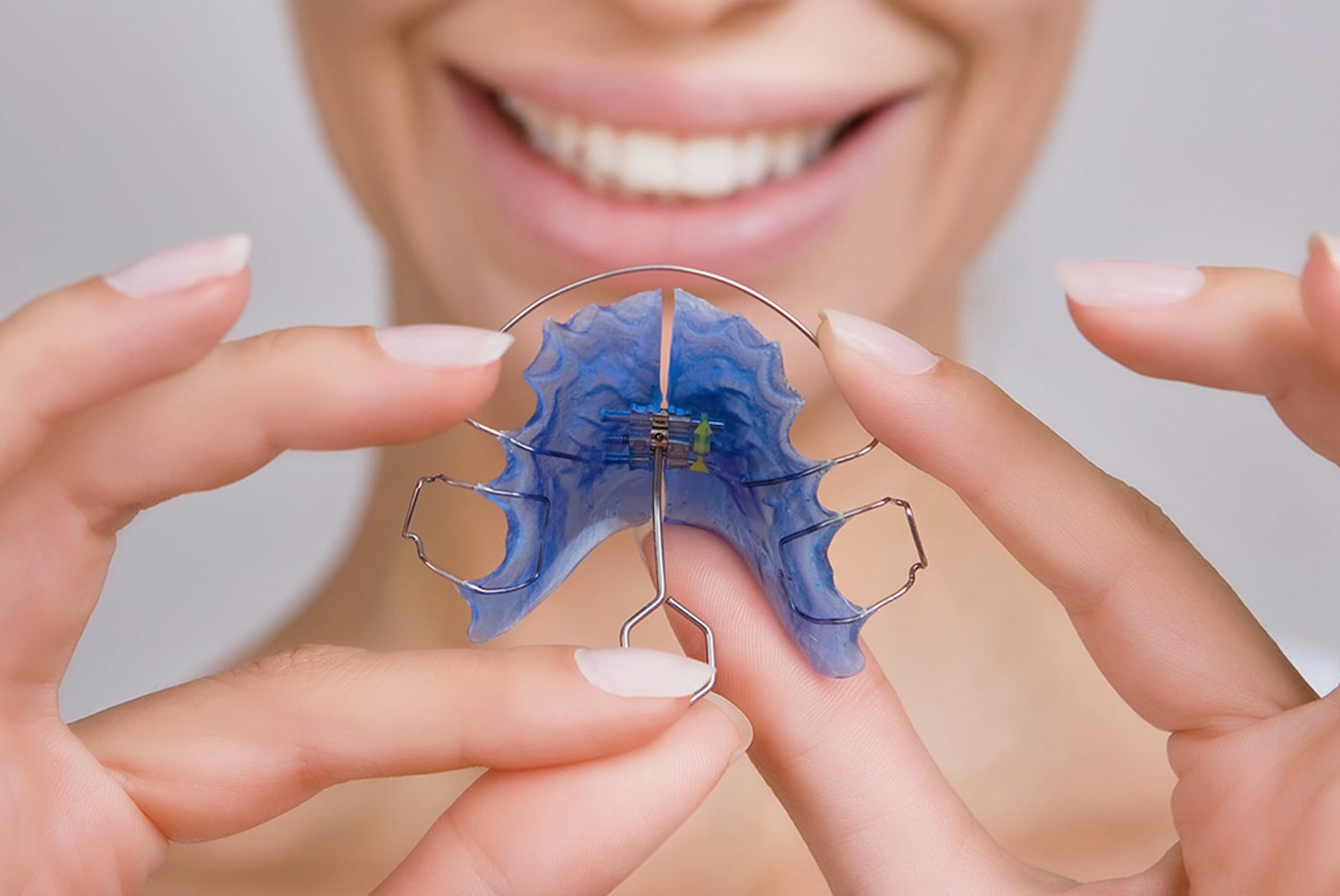 Tratamiento de ortodoncia con brackets autoligables Damon