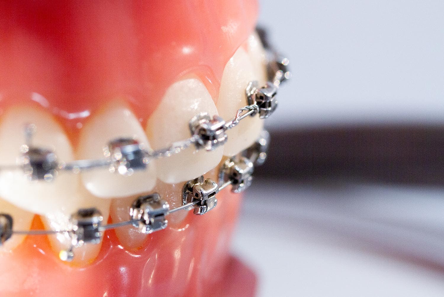 Tratamiento de ortodoncia con brackets autoligables Damon