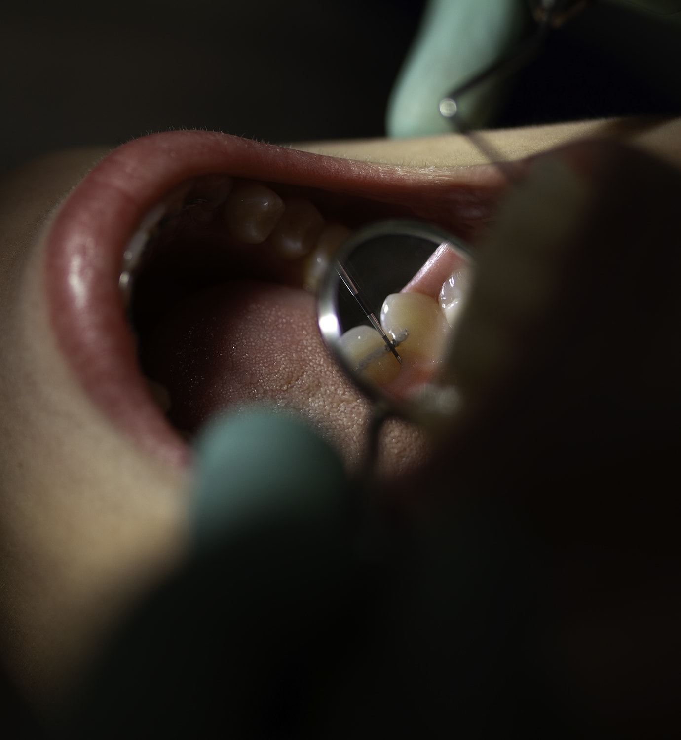Beneficios de la profilaxis dental