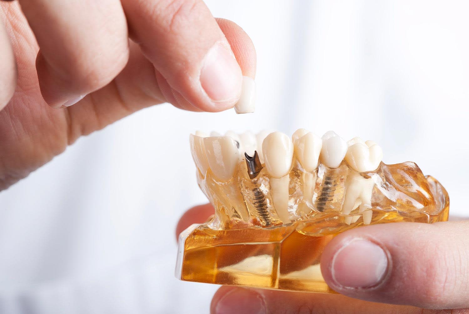 Proceso de osteointegración en implantes dentales