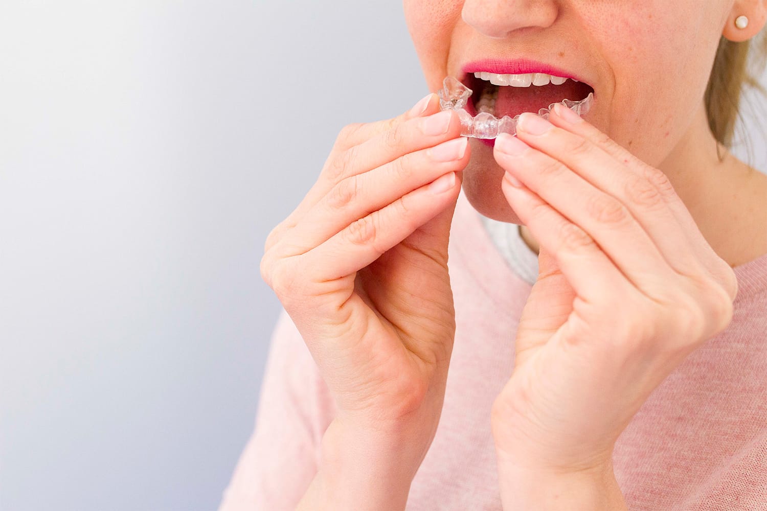Mujer colocándose su ortodoncia con invisalign