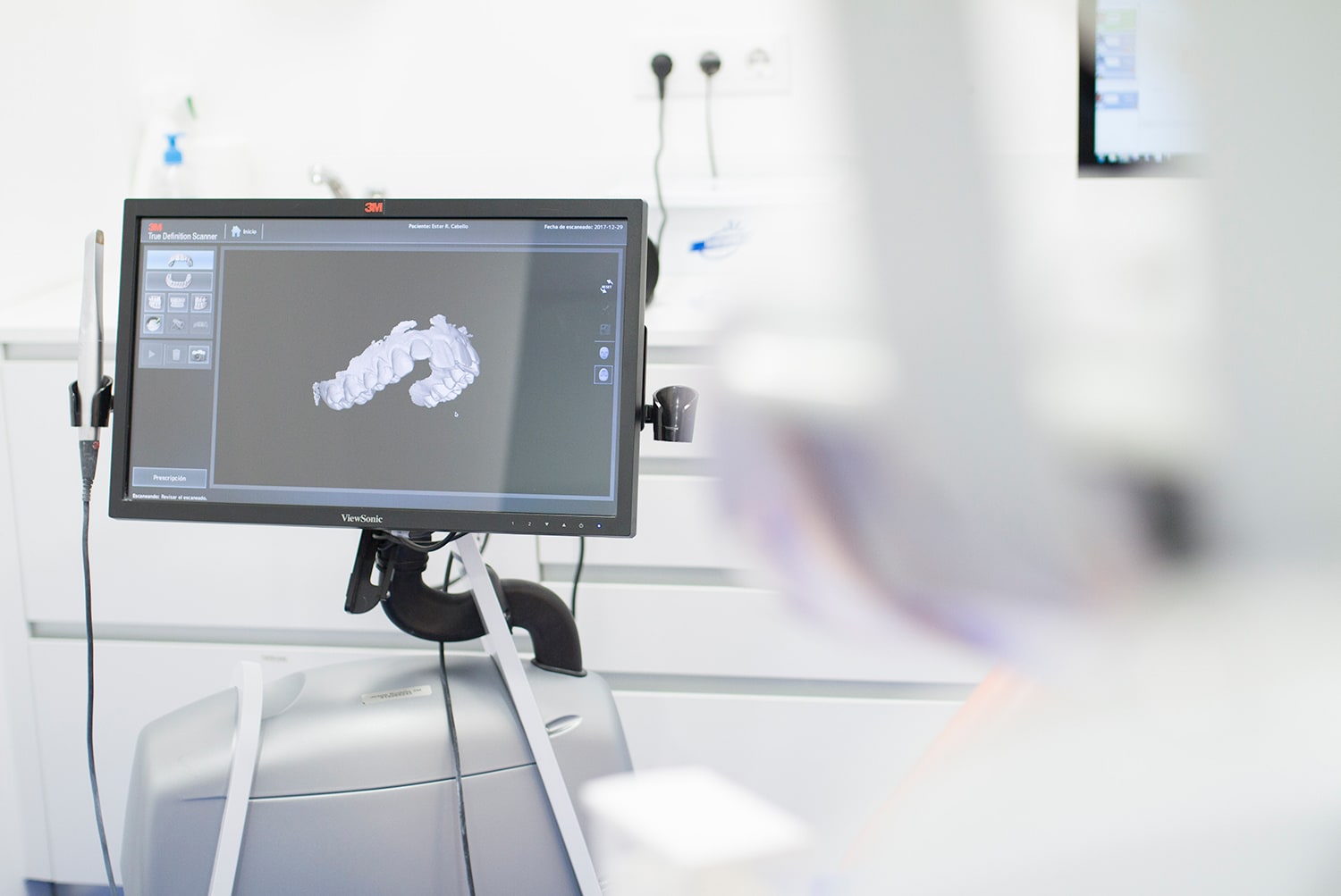 Método de ortodoncia con invisalign a medida paso a paso