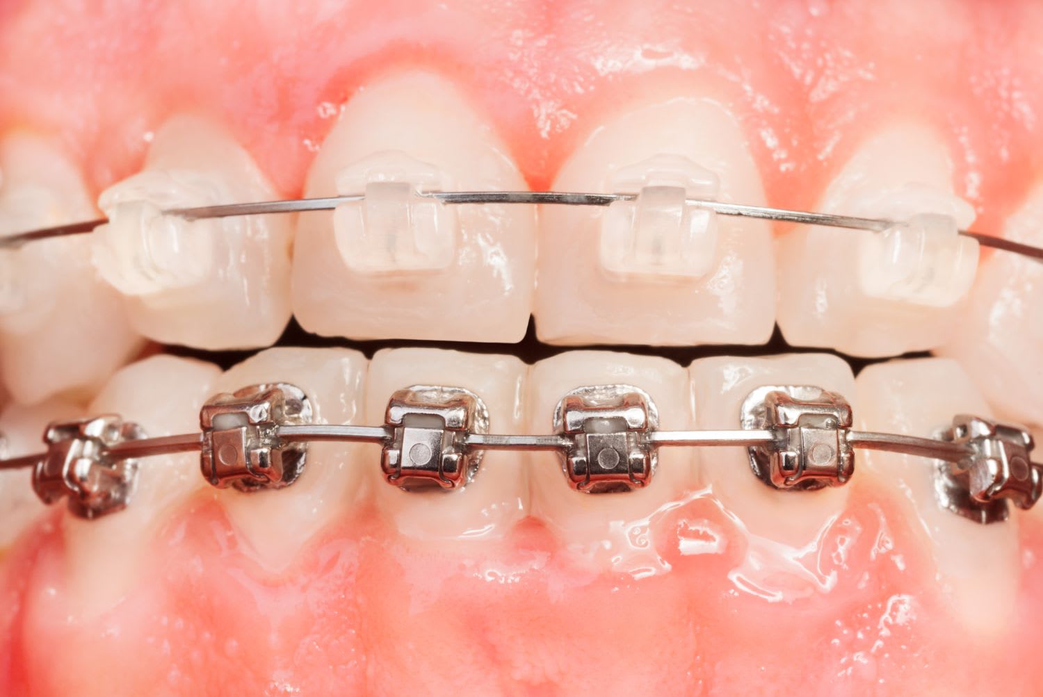 Brackets estéticos de zafiro