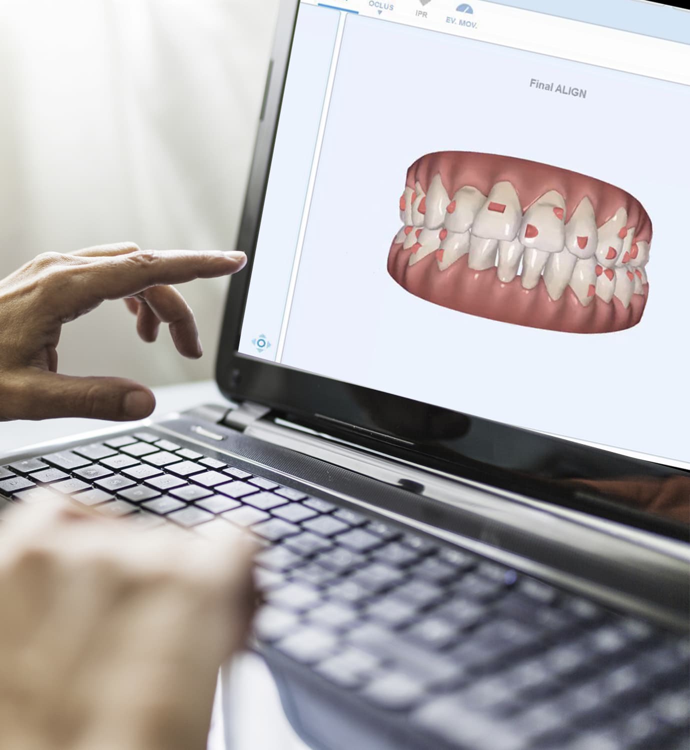 Dudas frecuentes sobre prótesis dentales